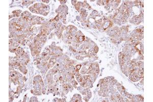 IHC-P Image Immunohistochemical analysis of paraffin-embedded NCIN87 xenograft , using PSAP, antibody at 1:500 dilution. (Prosaposin antibody)