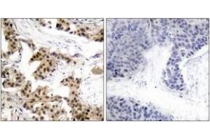 Immunohistochemistry analysis of paraffin-embedded human breast carcinoma, using NF-kappaB p105/p50 (Phospho-Ser893) Antibody. (NFKB1 antibody  (pSer893))