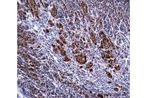 S100B antibody immunohistochemistry analysis in formalin fixed and paraffin embedded human malignant melanoma. (S100B antibody)