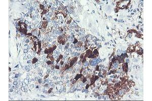 Immunohistochemical staining of paraffin-embedded Adenocarcinoma of Human breast tissue using anti-SERPINB2 mouse monoclonal antibody. (SERPINB2 antibody)