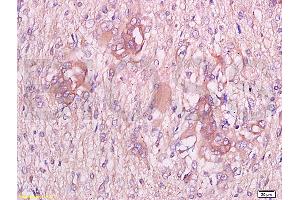 Formalin-fixed and paraffin embedded human endometrium carcinoma labeled with Anti-CGP-39/YKL-40 Polyclonal Antibody, Unconjugated at 1:300 followed by conjugation to the secondary antibody and DAB staining (CHI3L1 antibody  (AA 330-381))