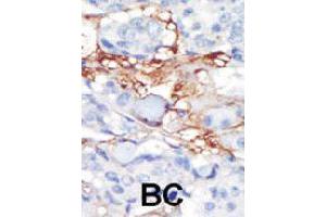 Formalin-fixed and paraffin-embedded human cancer tissue reacted with PDGFRL polyclonal antibody  , which was peroxidase-conjugated to the secondary antibody, followed by DAB staining. (PDGFRL antibody  (C-Term))