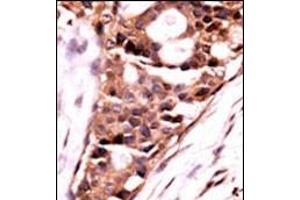 Formalin-fixed and paraffin-embedded human cancer tissue reacted with the primary antibody, which was peroxidase-conjugated to the secondary antibody, followed by AEC staining. (PPP3CB antibody  (N-Term))