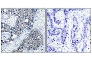 Immunohistochemical analysis of paraffin-embedded human breast carcinoma tissue using eIF4E(Phospho-Ser209) Antibody(left) or the same antibody preincubated with blocking peptide(right). (EIF4E antibody  (pSer209))