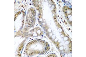 Immunohistochemistry of paraffin-embedded human colon carcinoma using TNFSF10 antibody (ABIN5971165) at dilution of 1/200 (40x lens). (TRAIL antibody)
