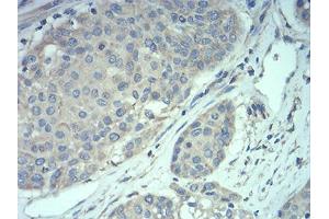 Immunohistochemical analysis of paraffin-embedded ovarian cancer tissues using MECP2 mouse mAb with DAB staining.