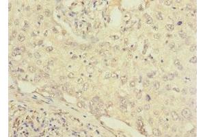 Immunohistochemistry of paraffin-embedded human lung cancer using ABIN7152656 at dilution of 1:100 (FCRL2 antibody  (AA 20-100))