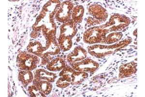 IHC-P Image Immunohistochemical analysis of paraffin-embedded human colon carcinoma, using Annexin A13, antibody at 1:500 dilution. (Annexin A13 antibody  (N-Term))
