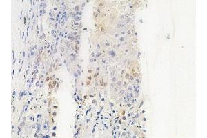 ABIN6263071 and ABIN6266879 at 1/100 staining human lung squamous cell carcinoma by IHC-P. (Melanoma Antigen Family D, 4 (MAGED4) (C-Term) antibody)