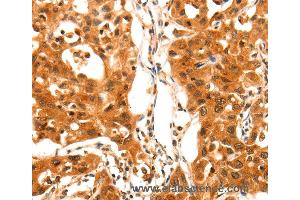 Immunohistochemistry of Human lung cancer using SERPINB5 Polyclonal Antibody at dilution of 1:60