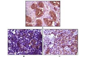 Immunohistochemical analysis of paraffin-embedded human breast tissue (A), lymph tissue (B) and skin carcinoma (C), showing membrane localization using BLK antibody with DAB staining. (BLK antibody)