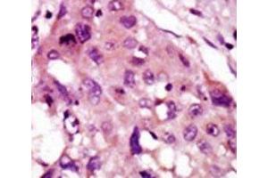 IHC analysis of FFPE human hepatocarcinoma tissue stained with the IRAK2 antibody (IRAK2 antibody  (AA 549-581))