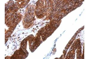IHC-P Image Thrombomodulin antibody [C3], C-term detects THBD protein at cytosol and membrane on human gastric cancer by immunohistochemical analysis.