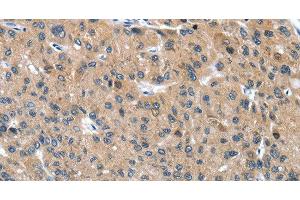 Immunohistochemistry of paraffin-embedded Human liver cancer tissue using DSC1 Polyclonal Antibody at dilution 1:40 (Desmocollin 1 antibody)