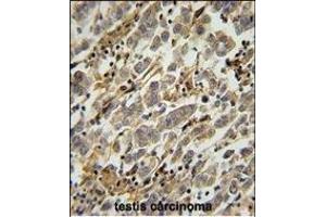 ASB17 Antibody (C-term) (ABIN654779 and ABIN2844460) immunohistochemistry analysis in formalin fixed and paraffin embedded human testis carcinoma followed by peroxidase conjugation of the secondary antibody and DAB staining. (ASB17 antibody  (C-Term))