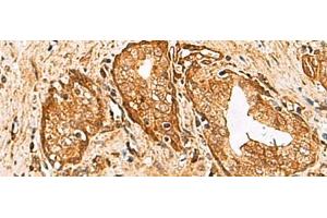 Immunohistochemistry of paraffin-embedded Human prost at e cancer tissue using DHRS2 Polyclonal Antibody at dilution of 1:55(x200) (DHRS2 antibody)