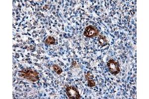 Immunohistochemical staining of paraffin-embedded Adenocarcinoma of colon tissue using anti-L1CAM mouse monoclonal antibody.