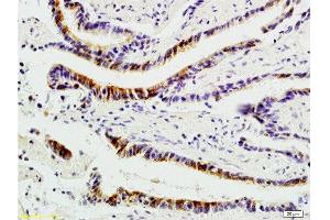 Formalin-fixed and paraffin-embedded : human colon carcinoma labeled with Rabbit Anti-Integrin αVβ1 Polyclonal Antibody , Unconjugated 1:200 followed by conjugation to the secondary antibody and DAB staining (ITGAV/ITGB1 antibody)
