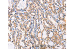 Immunohistochemistry of Human lung cancer using F13A1 Polyclonal Antibody at dilution of 1:80 (F13A1 antibody)