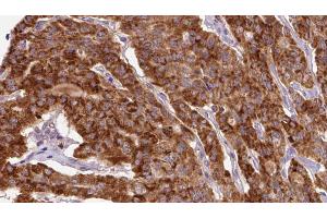 ABIN6267134 at 1/100 staining Human thyroid cancer tissue by IHC-P.