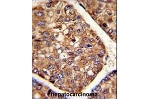 Formalin-fixed and paraffin-embedded human hepatocarcinoma reacted with P4HB Antibody (C-term), which was peroxidase-conjugated to the secondary antibody, followed by DAB staining.