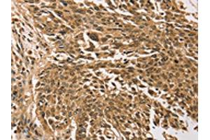The image on the left is immunohistochemistry of paraffin-embedded Human lung cancer tissue using ABIN7192784(TGM7 Antibody) at dilution 1/30, on the right is treated with synthetic peptide. (Transglutaminase 7 antibody)