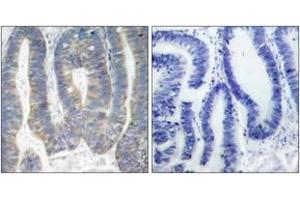 Immunohistochemistry analysis of paraffin-embedded human colon carcinoma, using PKR (Ab-451) Antibody. (EIF2AK2 antibody  (AA 418-467))
