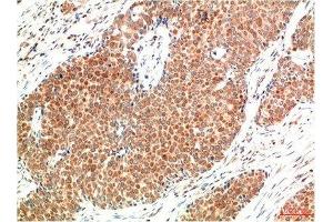 Immunohistochemical analysis of paraffin-embedded Human Breast Carcinoma Tissue using ATM Mouse mAb diluted at 1:200. (ATM antibody)