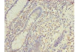 Immunohistochemistry of paraffin-embedded human colon cancer using ABIN7159710 at dilution of 1:100 (MFAP3L antibody  (AA 29-102))