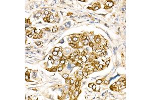 Immunohistochemistry of paraffin-embedded Human lung cancer using FasLG antibody (ABIN3020741, ABIN3020742, ABIN3020743, ABIN1512897 and ABIN6213701) at dilution of 1:150 (40x lens). (FASL antibody  (AA 100-200))