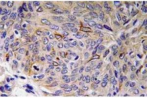 Immunohistochemistry (IHC) analyzes of IL-32 antibody in paraffin-embedded human lung carcinoma tissue. (IL32 antibody)