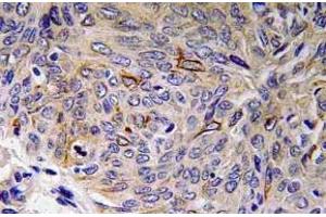 Immunohistochemistry (IHC) analyzes of IL-32 antibody in paraffin-embedded human lung carcinoma tissue. (IL32 antibody)