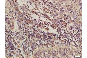 Formalin-fixed and paraffin embedded human laryngeal carcinoma labeled with Rabbit Anti-C4orf21 Polyclonal Antibody, Unconjugated (ABIN1714408) at 1:200 followed by conjugation to the secondary antibody and DAB staining (ZGRF1 antibody  (AA 101-200))