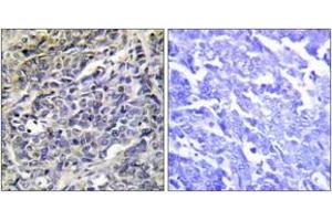Immunohistochemistry analysis of paraffin-embedded human lung carcinoma tissue, using GRAK Antibody.
