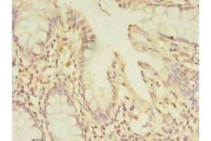 Immunohistochemistry of paraffin-embedded human colon cancer using ABIN7165911 at dilution of 1:100 (PELO antibody  (AA 1-385))