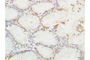 Formalin-fixed and paraffin embedded human gastric carcinoma labeled with Anti-phospho-YES1(Tyr426) Polyclonal Antibody, Unconjugated  at 1:200 followed by conjugation to the secondary antibody and DAB staining