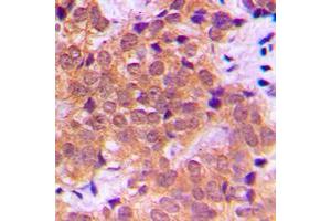 Immunohistochemical analysis of NF-kappaB p65 (pS468) staining in human breast cancer formalin fixed paraffin embedded tissue section. (NF-kB p65 antibody  (C-Term, pSer468))