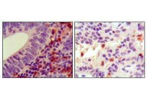 Immunohistochemical analysis of paraffin-embedded human colon cancer (left) and ancreas cancer (right), showing cytoplasmic localization using HCK antibody with DAB staining.