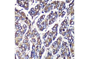 Immunohistochemistry of paraffin-embedded Human liver cancer using UGT1 Rabbit pAb (ABIN6132769, ABIN6149895, ABIN6149896 and ABIN6221779) at dilution of 1:100 (40x lens).