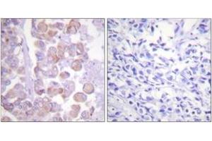 Immunohistochemistry analysis of paraffin-embedded human breast carcinoma tissue, using Synuclein (Ab-129) Antibody. (Synuclein antibody  (AA 91-140))