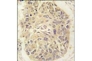 Formalin-fixed and paraffin-embedded human lung carcinoma tissue reacted with FARSA antibody (N-term), which was peroxidase-conjugated to the secondary antibody, followed by DAB staining. (Phenylalanyl-tRNA Synthetase, alpha Subunit (FARSA) (N-Term) antibody)