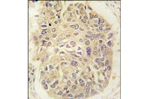 Formalin-fixed and paraffin-embedded human lung carcinoma tissue reacted with FARSA antibody (N-term), which was peroxidase-conjugated to the secondary antibody, followed by DAB staining.