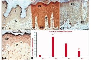 The effects of ustekinumab and the CUC on the immunoexpression (IE) of TNF-α in IQ-induced psoriatic skin lesions. (TNF alpha antibody)