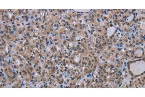 Immunohistochemistry of paraffin-embedded Human thyroid cancer tissue using MAGEC1 Polyclonal Antibody at dilution 1:30 (MAGEC1 antibody)