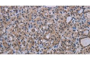 Immunohistochemistry of paraffin-embedded Human thyroid cancer tissue using MAGEC1 Polyclonal Antibody at dilution 1:30