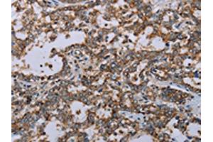 The image on the left is immunohistochemistry of paraffin-embedded Human liver cancer tissue using ABIN7191485(MMP23B Antibody) at dilution 1/20, on the right is treated with synthetic peptide. (MMP23A antibody)