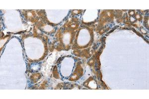 Immunohistochemistry of paraffin-embedded Human thyroid cancer using PPP2CA Polyclonal Antibody at dilution of 1:35 (PPP2CA antibody)