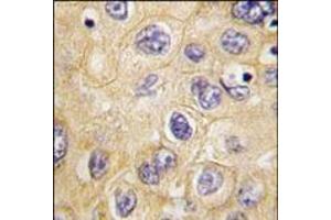 Formalin-fixed and paraffin-embedded human hepatocarcinoma tissue reacted with hCLDN1-Loop1, which was peroxidase-conjugated to the secondary antibody, followed by DAB staining. (Claudin 1 antibody  (Loop 1))