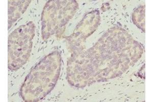 Immunohistochemistry of paraffin-embedded human gastric cancer using ABIN7162209 at dilution of 1:100 (Oligophrenin 1 antibody  (AA 1-270))