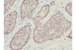 Immunohistochemistry of paraffin-embedded human gastric cancer using ABIN7162209 at dilution of 1:100